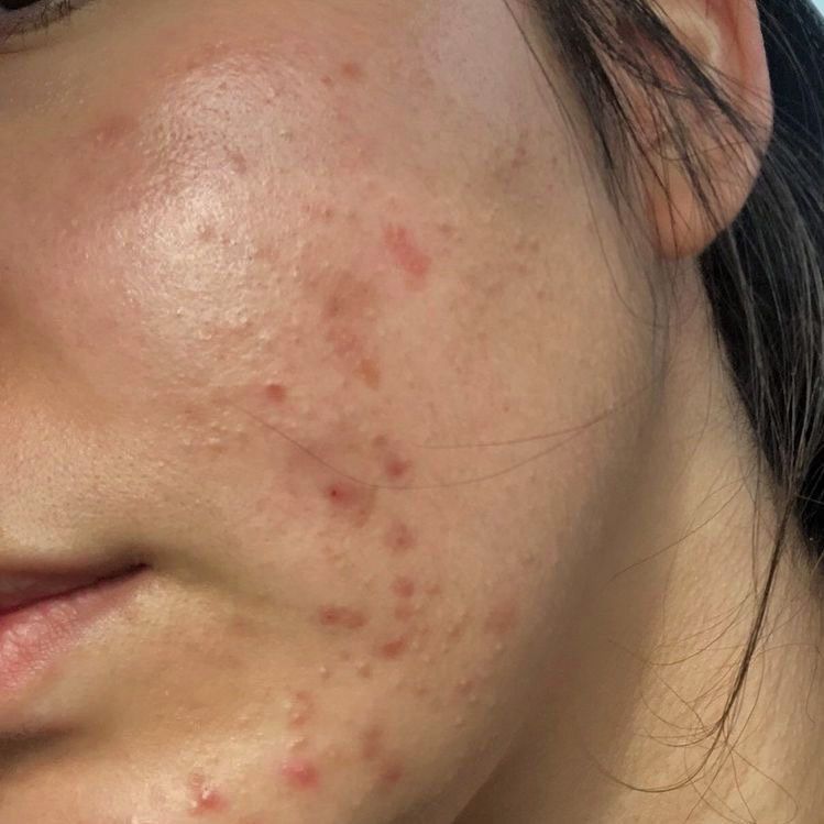 Acne Treatment