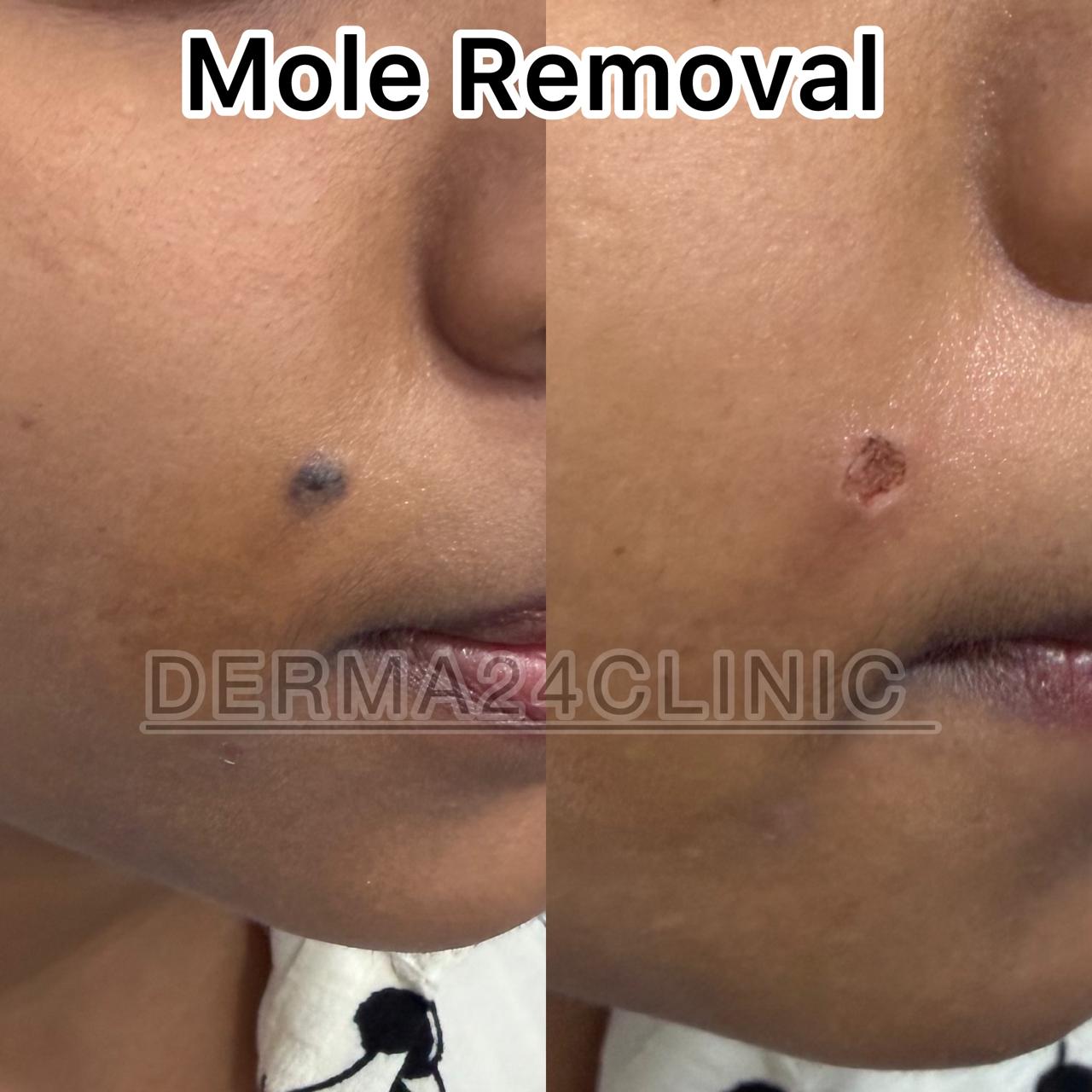 Advanced Laser Treatment