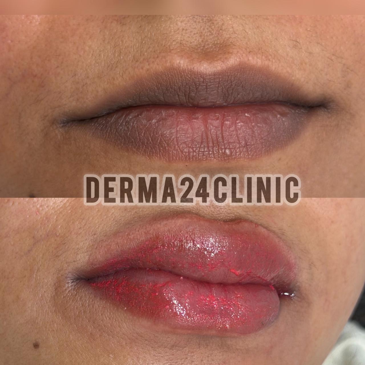 Advanced Laser Treatment