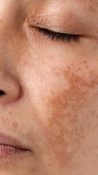 Sunlight on skin surface background representation