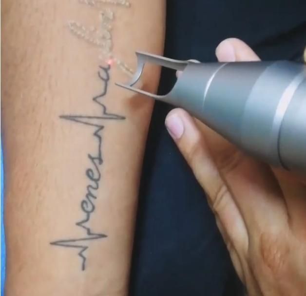 Tattoo Removal Treatment